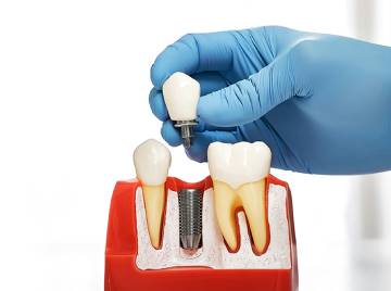 How to Care for Your Dental Implants for Long-Lasting Results
