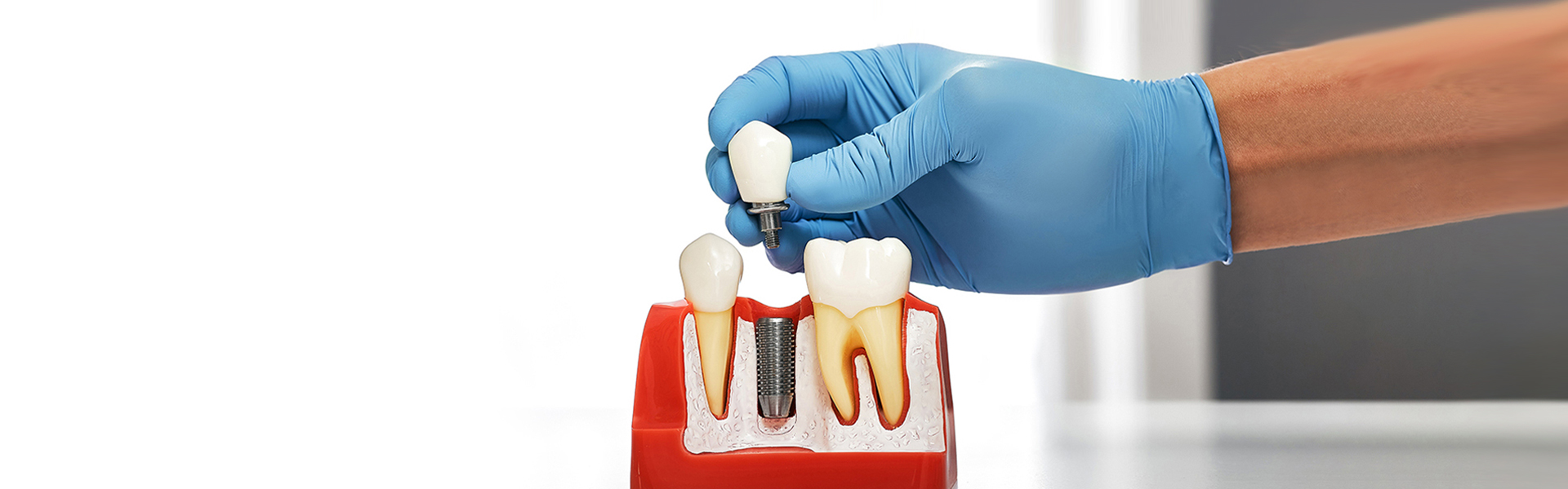 How to Care for Your Dental Implants for Long-Lasting Results