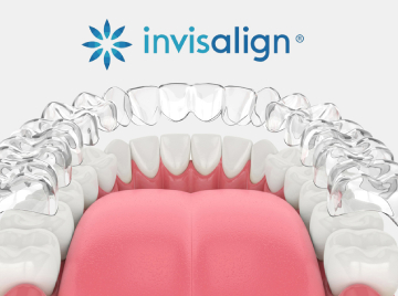 How Invisalign Straightens Teeth Without Metal Braces